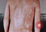 Standbild flash Brennen auf junge Opfer der Atombombe Nagasaki Japan, 1946, aus Sekunde 17 historischem Filmmaterial Videoclip 65675042178