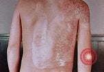 Standbild flash Brennen auf junge Opfer der Atombombe Nagasaki Japan, 1946, aus Sekunde 18 historischem Filmmaterial Videoclip 65675042178