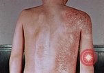 Standbild flash Brennen auf junge Opfer der Atombombe Nagasaki Japan, 1946, aus Sekunde 21 historischem Filmmaterial Videoclip 65675042178