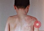 Standbild flash Brennen auf junge Opfer der Atombombe Nagasaki Japan, 1946, aus Sekunde 28 historischem Filmmaterial Videoclip 65675042178