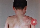 Standbild flash Brennen auf junge Opfer der Atombombe Nagasaki Japan, 1946, aus Sekunde 29 historischem Filmmaterial Videoclip 65675042178