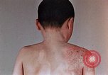 Standbild flash Brennen auf junge Opfer der Atombombe Nagasaki Japan, 1946, aus Sekunde 30 historischem Filmmaterial Videoclip 65675042178