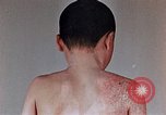 Standbild flash Brennen auf junge Opfer der Atombombe Nagasaki Japan, 1946, aus Sekunde 31 historischem Filmmaterial Videoclip 65675042178
