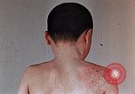 Standbild flash Brennen auf junge Opfer der Atombombe Nagasaki Japan, 1946, aus Sekunde 32 historischem Filmmaterial Videoclip 65675042178