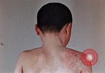 Standbild flash Brennen auf junge Opfer der Atombombe Nagasaki Japan, 1946, aus Sekunde 33 historischem Filmmaterial Videoclip 65675042178