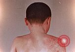 Standbild flash Brennen auf junge Opfer der Atombombe Nagasaki Japan, 1946, aus Sekunde 34 historischem Filmmaterial Videoclip 65675042178