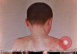Standbild flash Brennen auf junge Opfer der Atombombe Nagasaki Japan, 1946, aus Sekunde 35 historischem Filmmaterial Videoclip 65675042178