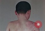 Standbild flash Brennen auf junge Opfer der Atombombe Nagasaki Japan, 1946, aus Sekunde 36 historischem Filmmaterial Videoclip 65675042178