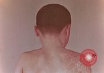 Standbild flash Brennen auf junge Opfer der Atombombe Nagasaki Japan, 1946, aus Sekunde 37 historischem Filmmaterial Videoclip 65675042178