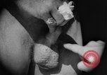 Image of skin burned by gas attack on WWI soldiers France, 1918, second 25 stock footage video 65675042403