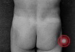 Image of skin burned by gas attack on WWI soldiers France, 1918, second 29 stock footage video 65675042403