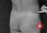 Image of skin burned by gas attack on WWI soldiers France, 1918, second 36 stock footage video 65675042403