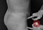 Image of skin burned by gas attack on WWI soldiers France, 1918, second 39 stock footage video 65675042403