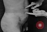 Image of skin burned by gas attack on WWI soldiers France, 1918, second 41 stock footage video 65675042403