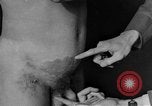 Image of skin burned by gas attack on WWI soldiers France, 1918, second 43 stock footage video 65675042403