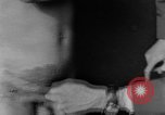 Image of skin burned by gas attack on WWI soldiers France, 1918, second 44 stock footage video 65675042403