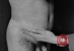 Image of skin burned by gas attack on WWI soldiers France, 1918, second 46 stock footage video 65675042403
