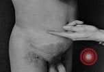 Image of skin burned by gas attack on WWI soldiers France, 1918, second 47 stock footage video 65675042403