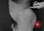 Image of skin burned by gas attack on WWI soldiers France, 1918, second 56 stock footage video 65675042403
