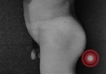 Image of skin burned by gas attack on WWI soldiers France, 1918, second 58 stock footage video 65675042403