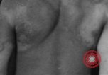 Image of skin burned by gas attack on WWI soldiers France, 1918, second 61 stock footage video 65675042403