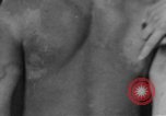 Image of skin burned by gas attack on WWI soldiers France, 1918, second 62 stock footage video 65675042403