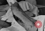 Image of operating a leg France, 1918, second 29 stock footage video 65675042404
