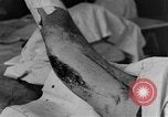Image of operating a leg France, 1918, second 30 stock footage video 65675042404