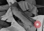 Image of operating a leg France, 1918, second 31 stock footage video 65675042404