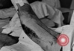 Image of operating a leg France, 1918, second 32 stock footage video 65675042404