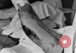Image of operating a leg France, 1918, second 35 stock footage video 65675042404