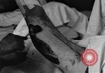 Image of operating a leg France, 1918, second 38 stock footage video 65675042404