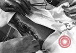 Image of operating a leg France, 1918, second 46 stock footage video 65675042404