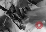 Image of operating a leg France, 1918, second 55 stock footage video 65675042404