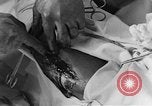 Image of operating a leg France, 1918, second 57 stock footage video 65675042404