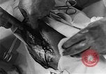 Image of operating a leg France, 1918, second 61 stock footage video 65675042404
