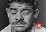 Image of eye injuries from gas attack during World War I France, 1918, second 8 stock footage video 65675042405