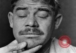 Image of eye injuries from gas attack during World War I France, 1918, second 10 stock footage video 65675042405