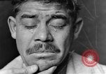 Image of eye injuries from gas attack during World War I France, 1918, second 11 stock footage video 65675042405