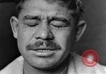 Image of eye injuries from gas attack during World War I France, 1918, second 12 stock footage video 65675042405