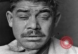 Image of eye injuries from gas attack during World War I France, 1918, second 14 stock footage video 65675042405