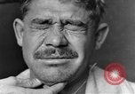 Image of eye injuries from gas attack during World War I France, 1918, second 15 stock footage video 65675042405