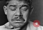 Image of eye injuries from gas attack during World War I France, 1918, second 16 stock footage video 65675042405