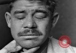 Image of eye injuries from gas attack during World War I France, 1918, second 17 stock footage video 65675042405