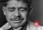 Image of eye injuries from gas attack during World War I France, 1918, second 19 stock footage video 65675042405