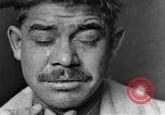 Image of eye injuries from gas attack during World War I France, 1918, second 20 stock footage video 65675042405