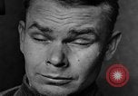 Image of eye injuries from gas attack during World War I France, 1918, second 27 stock footage video 65675042405