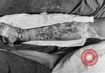 Image of eye injuries from gas attack during World War I France, 1918, second 54 stock footage video 65675042405