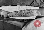 Image of eye injuries from gas attack during World War I France, 1918, second 56 stock footage video 65675042405