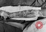 Image of eye injuries from gas attack during World War I France, 1918, second 58 stock footage video 65675042405